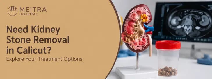 Kidney Stone Removal in Calicut 1