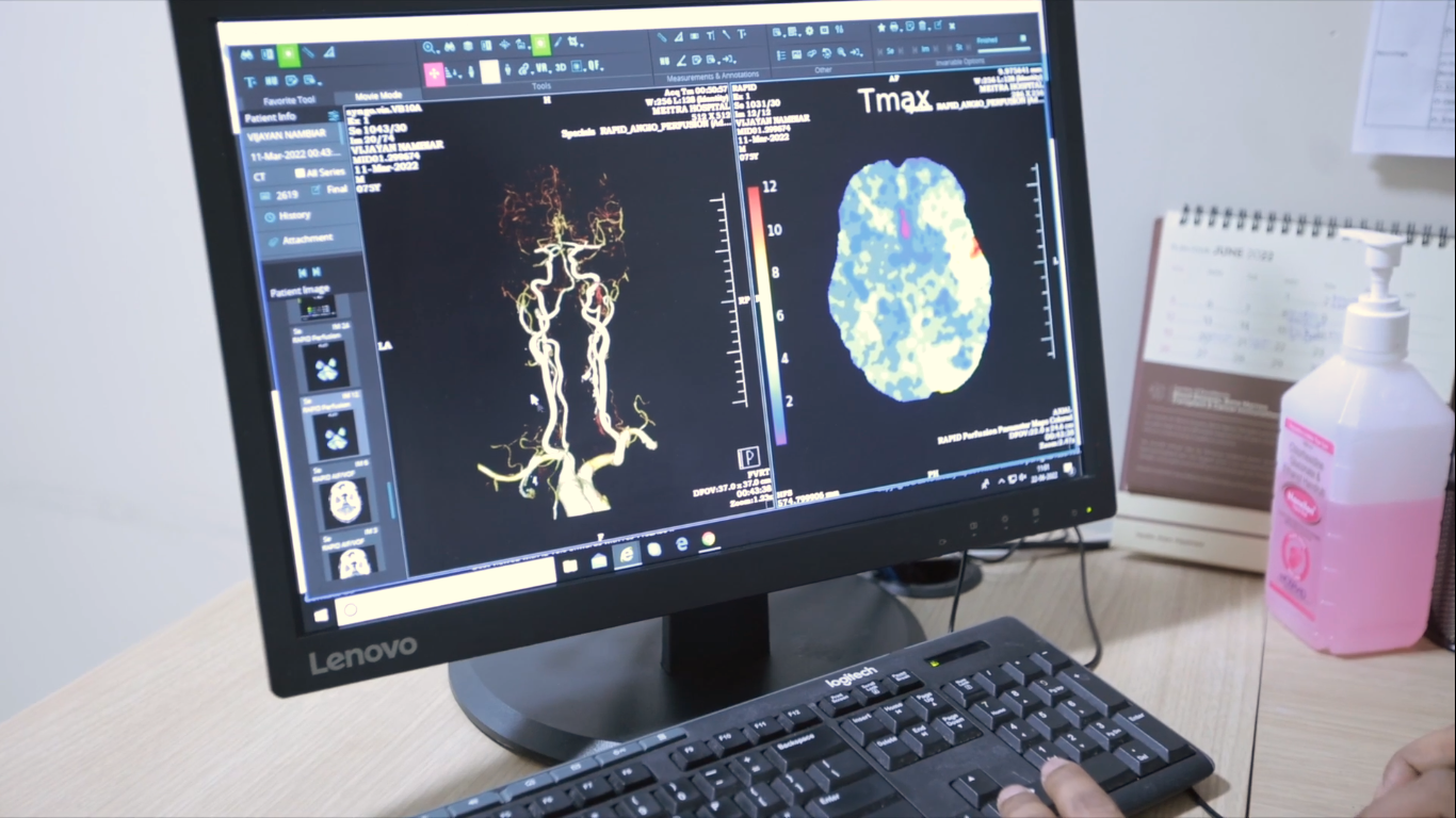 24/7 Acute Stroke Management integrated with Rapid AI and dedicated Emergency Pathway