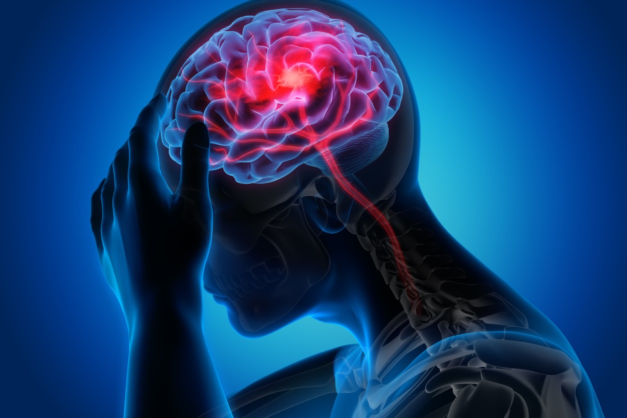 World Stroke Day | Why Doctors Vouch for Neuro Interventional Procedures to Manage Stroke?
