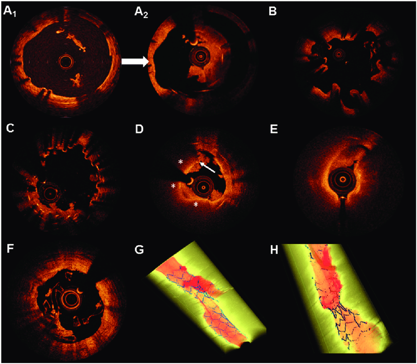 Intra-Vascular Ultrasound and Optical Coherence Tomography for Critical Coronary Imaging
