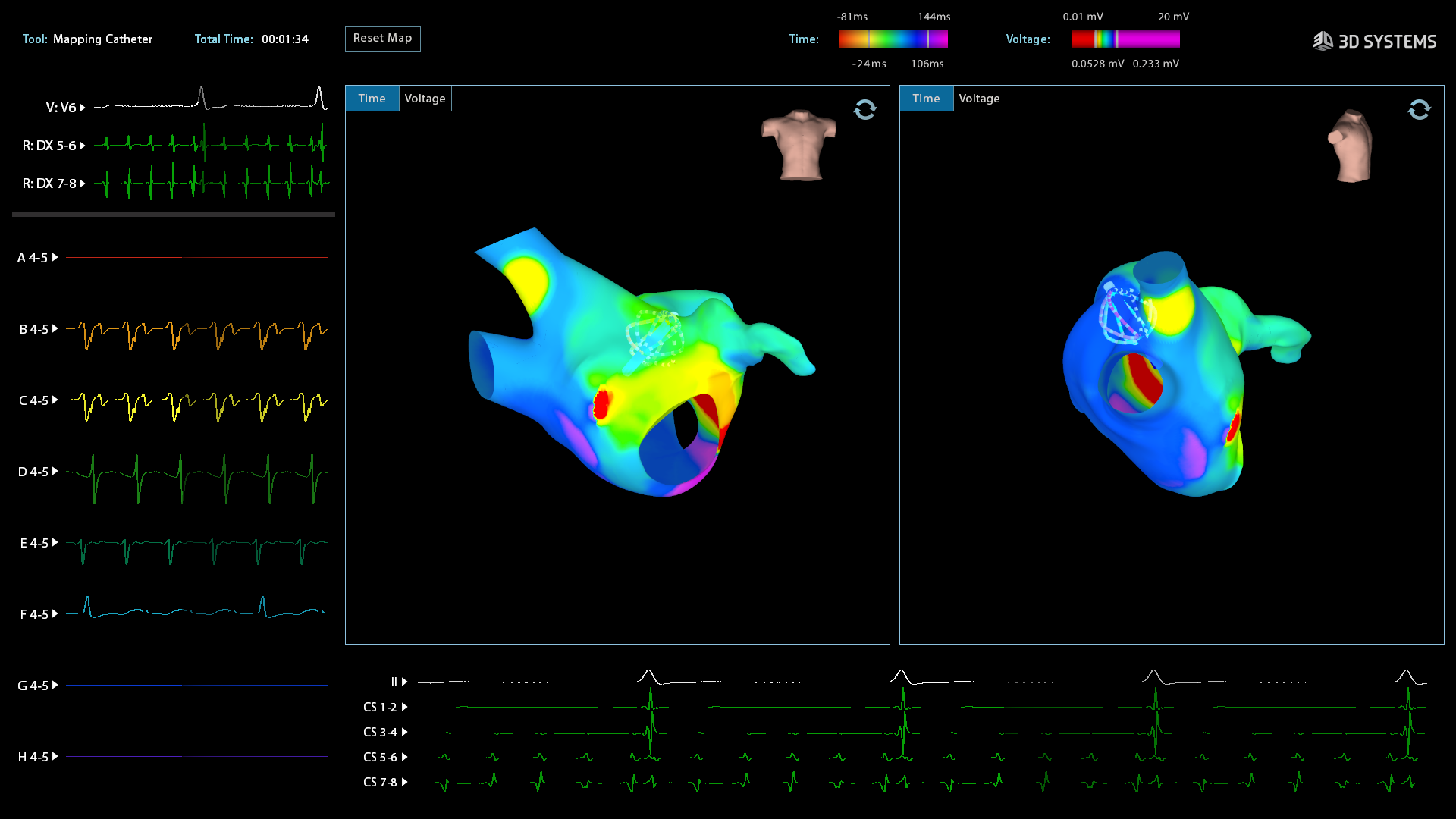 3D Mapping for Electrophysiology Study and Ablation